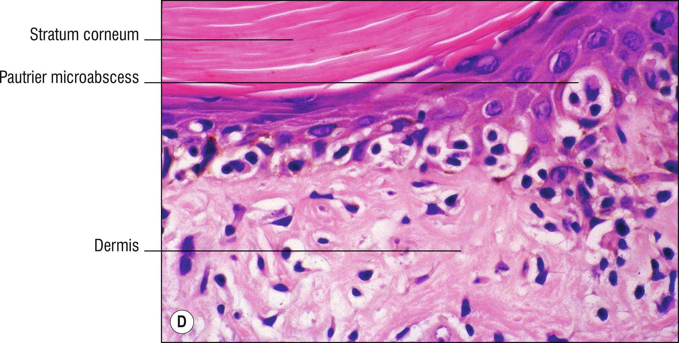 Fig. 24.1, D Mycosis fungoides (high mag.).