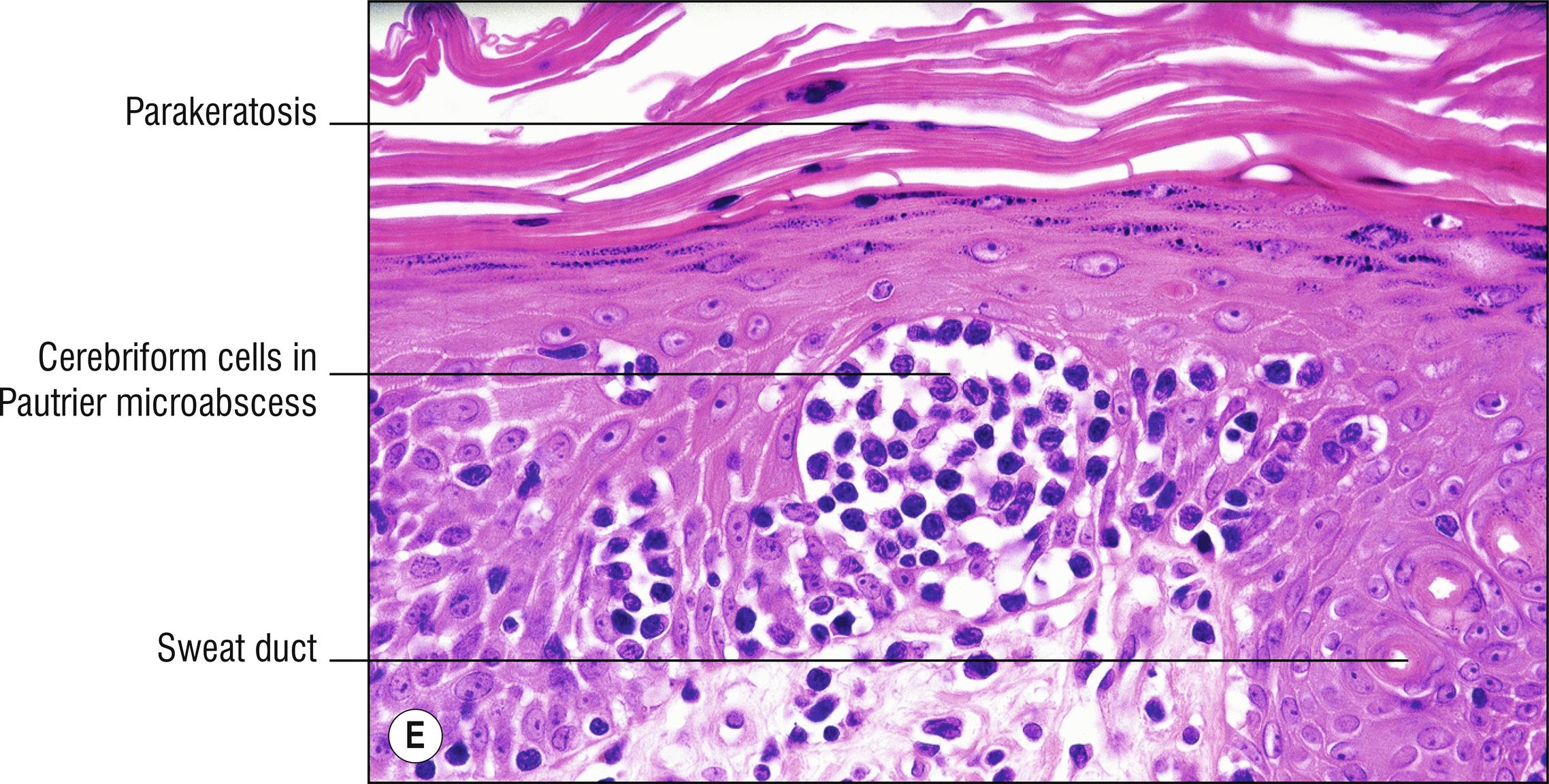 Fig. 24.1, E Mycosis fungoides (high mag.).