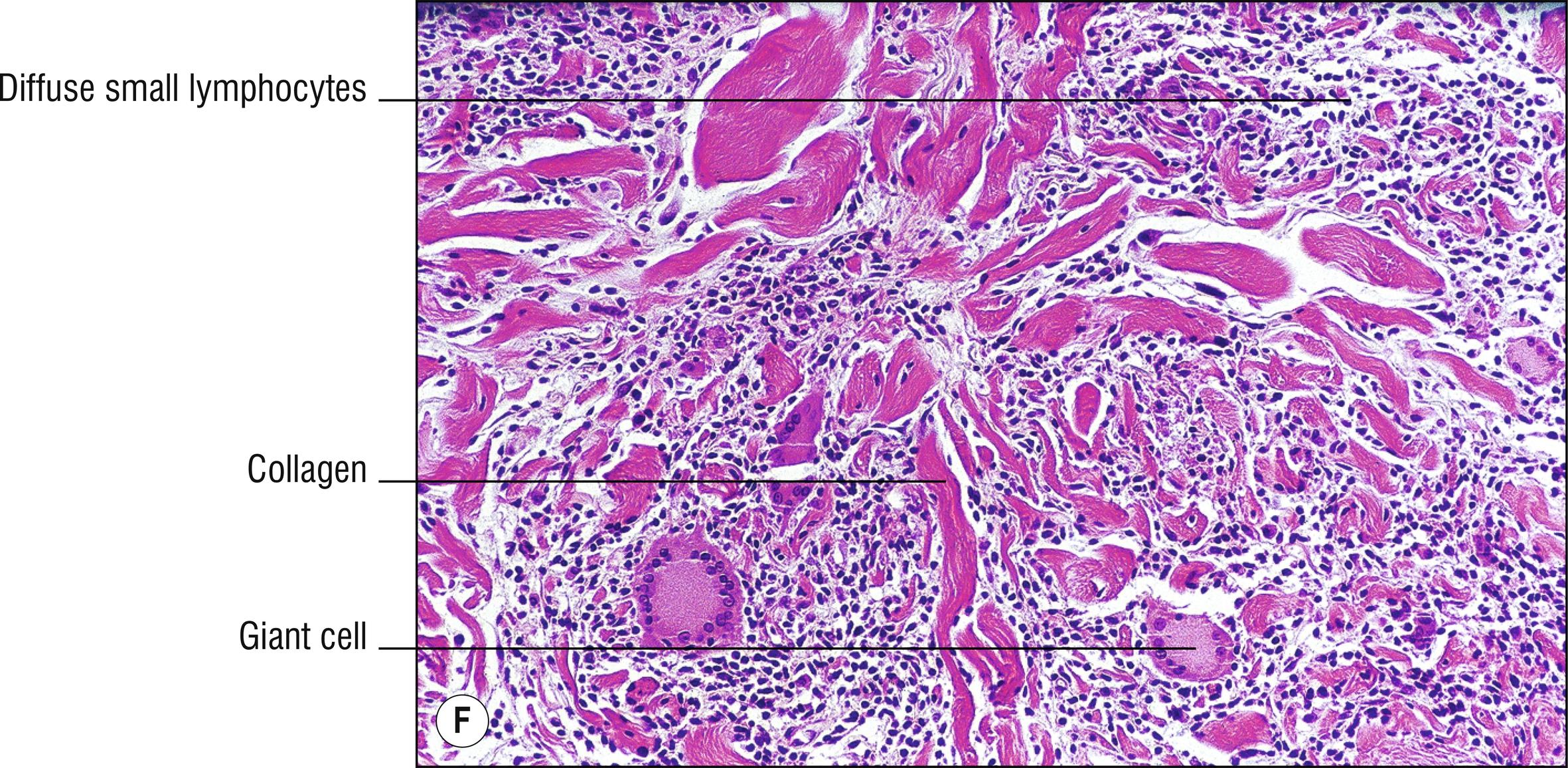 Fig. 24.1, F Granulomatous slack skin.