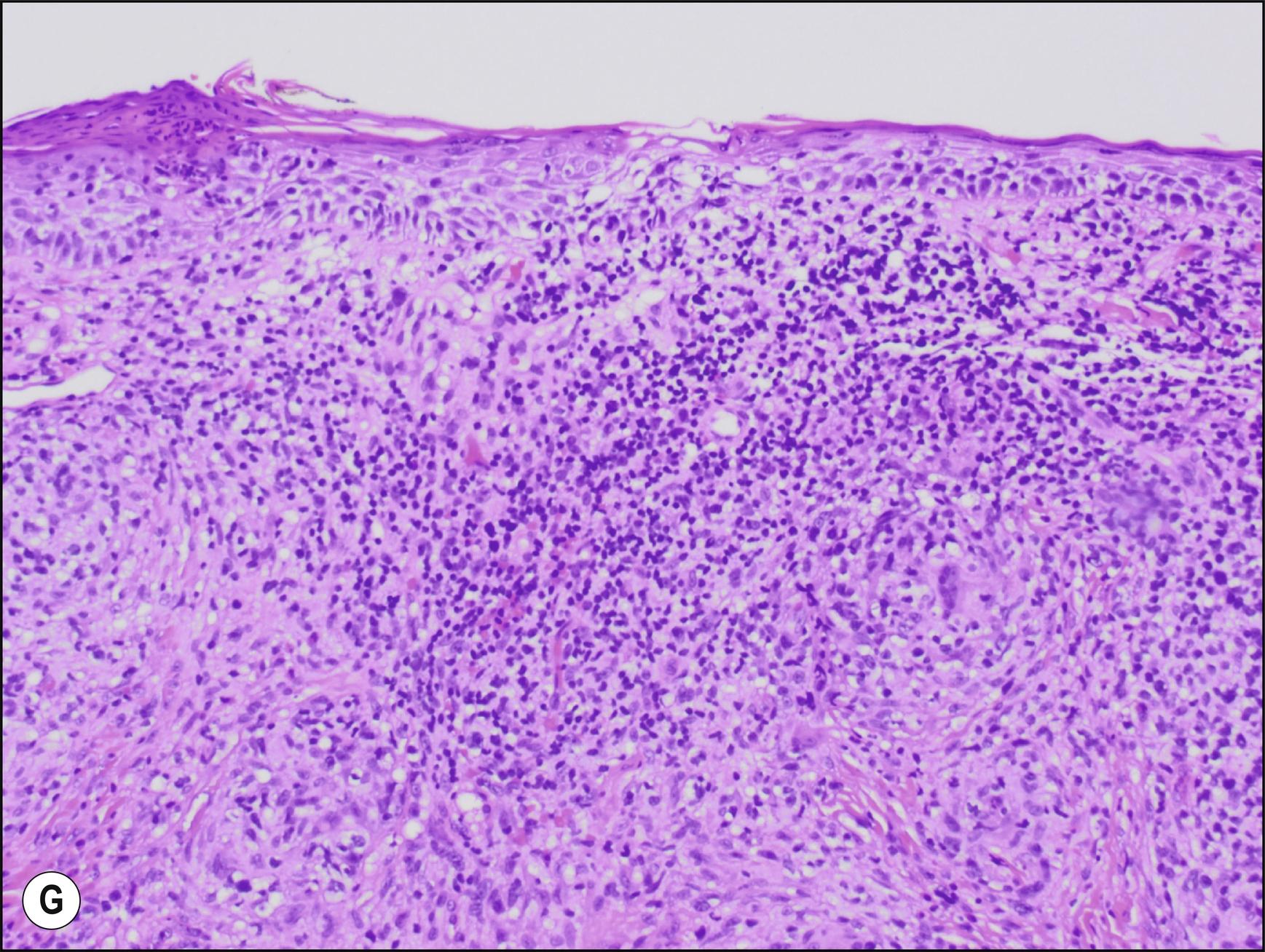 Fig. 24.1, G Granulomatous mycosis fungoides.