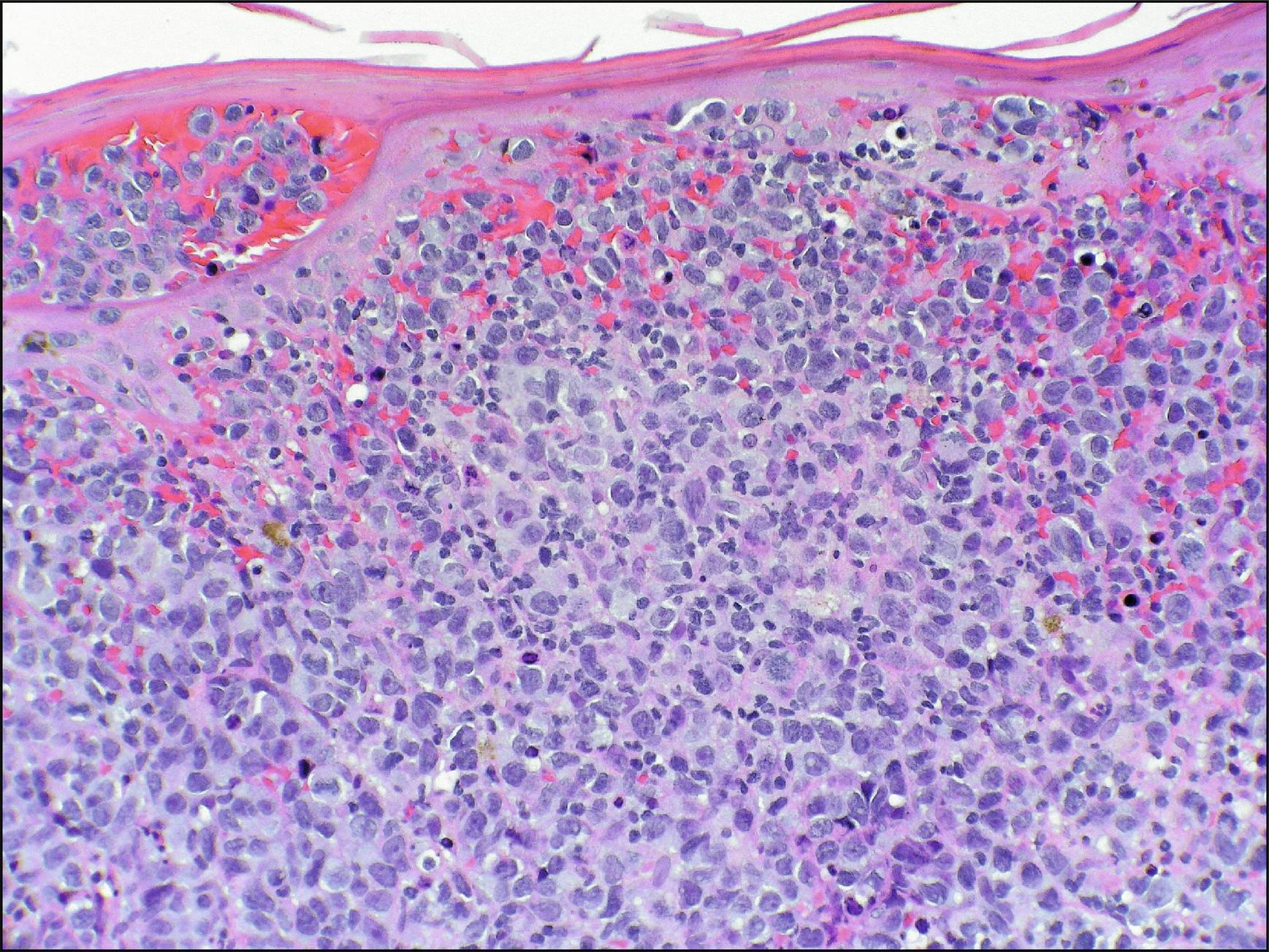 Fig. 24.2, Sezary syndrome.