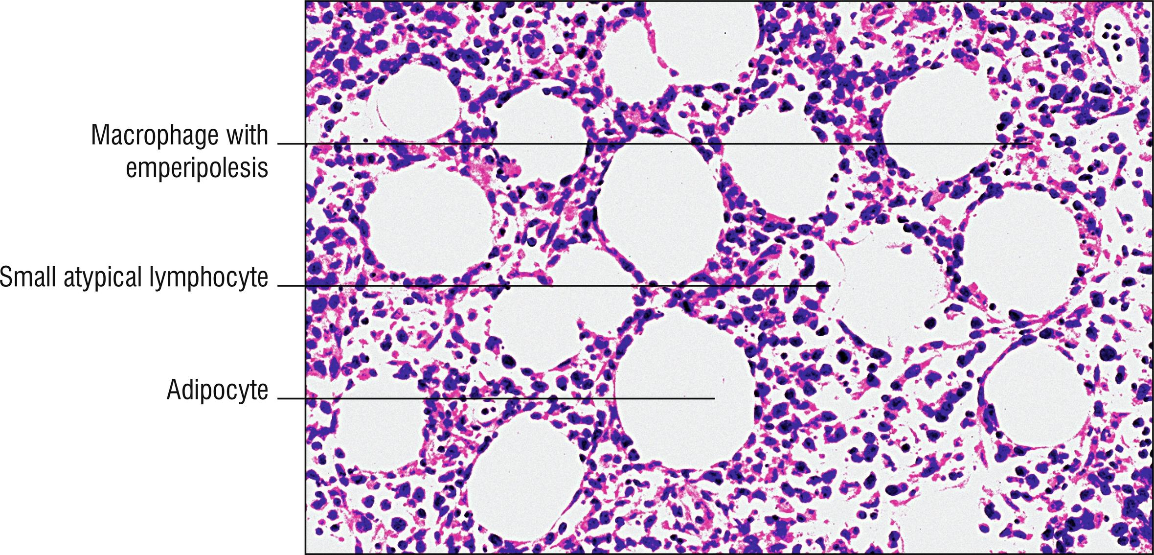 Fig. 24.4, Subcutaneous T-cell lymphoma.