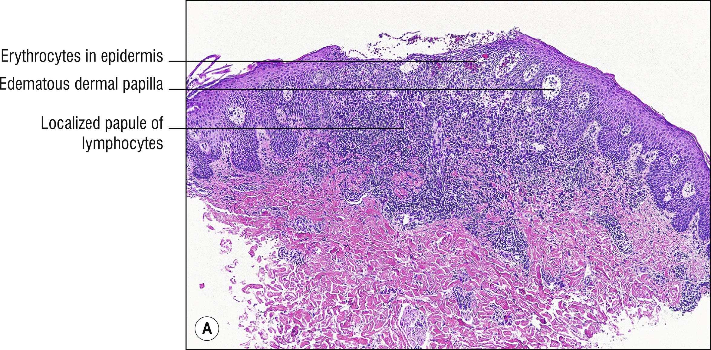 Fig. 24.5, A Lymphomatoid papulosis (low mag.).