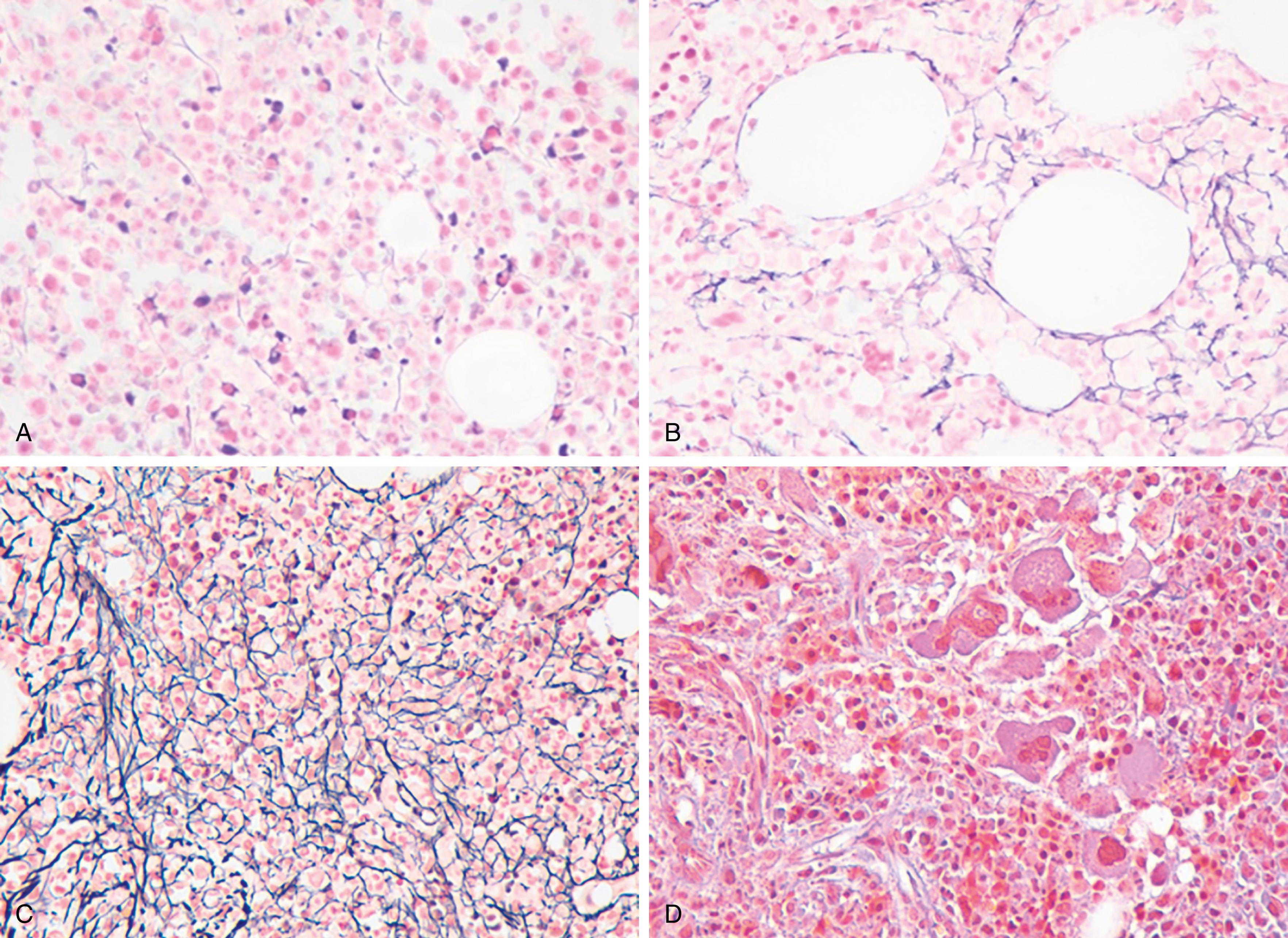 Fig. 5.1, European Consensus grading scale for bone marrow fibrosis.