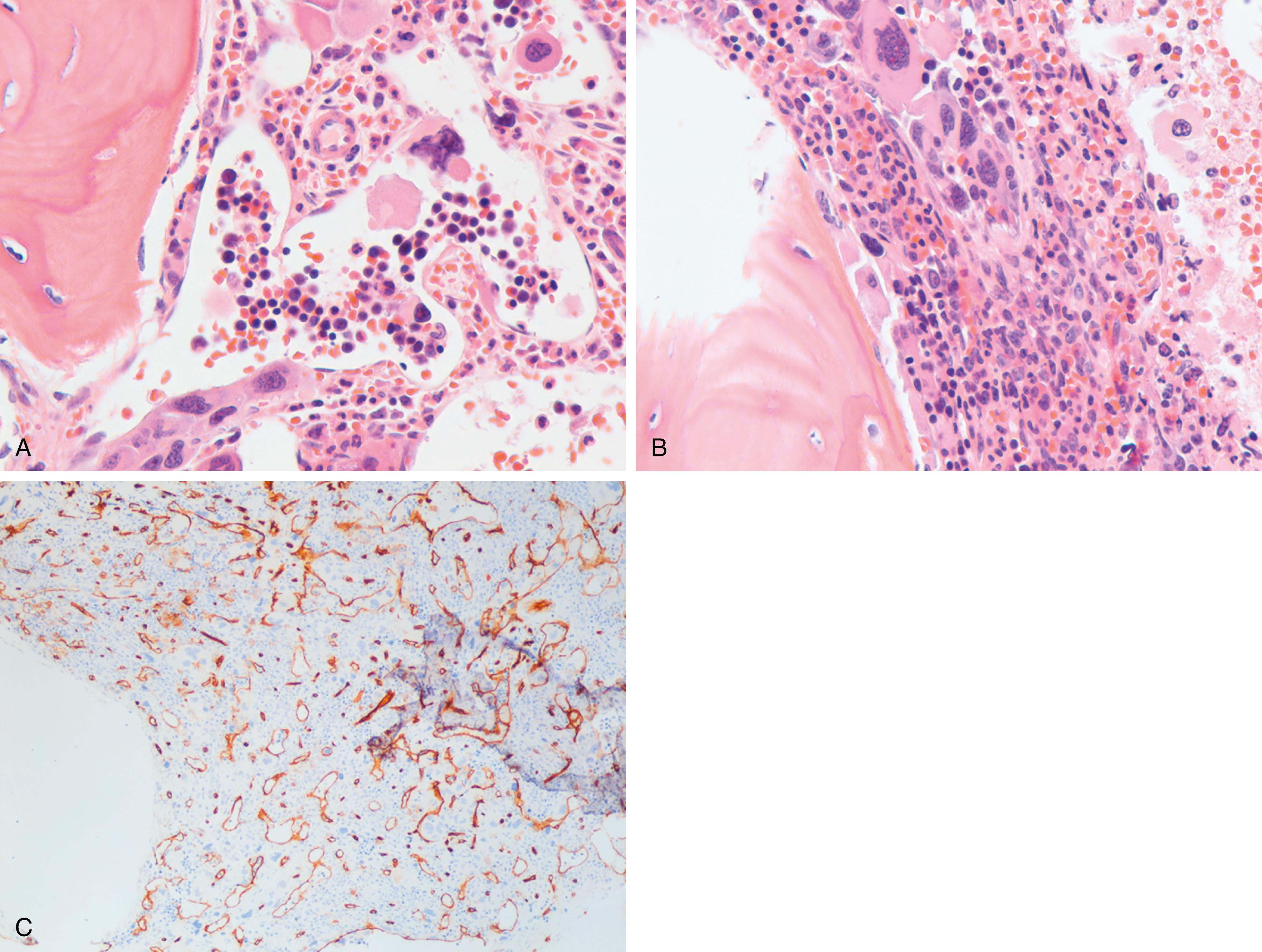 Fig. 5.2, Changes associated with bone marrow fibrosis.