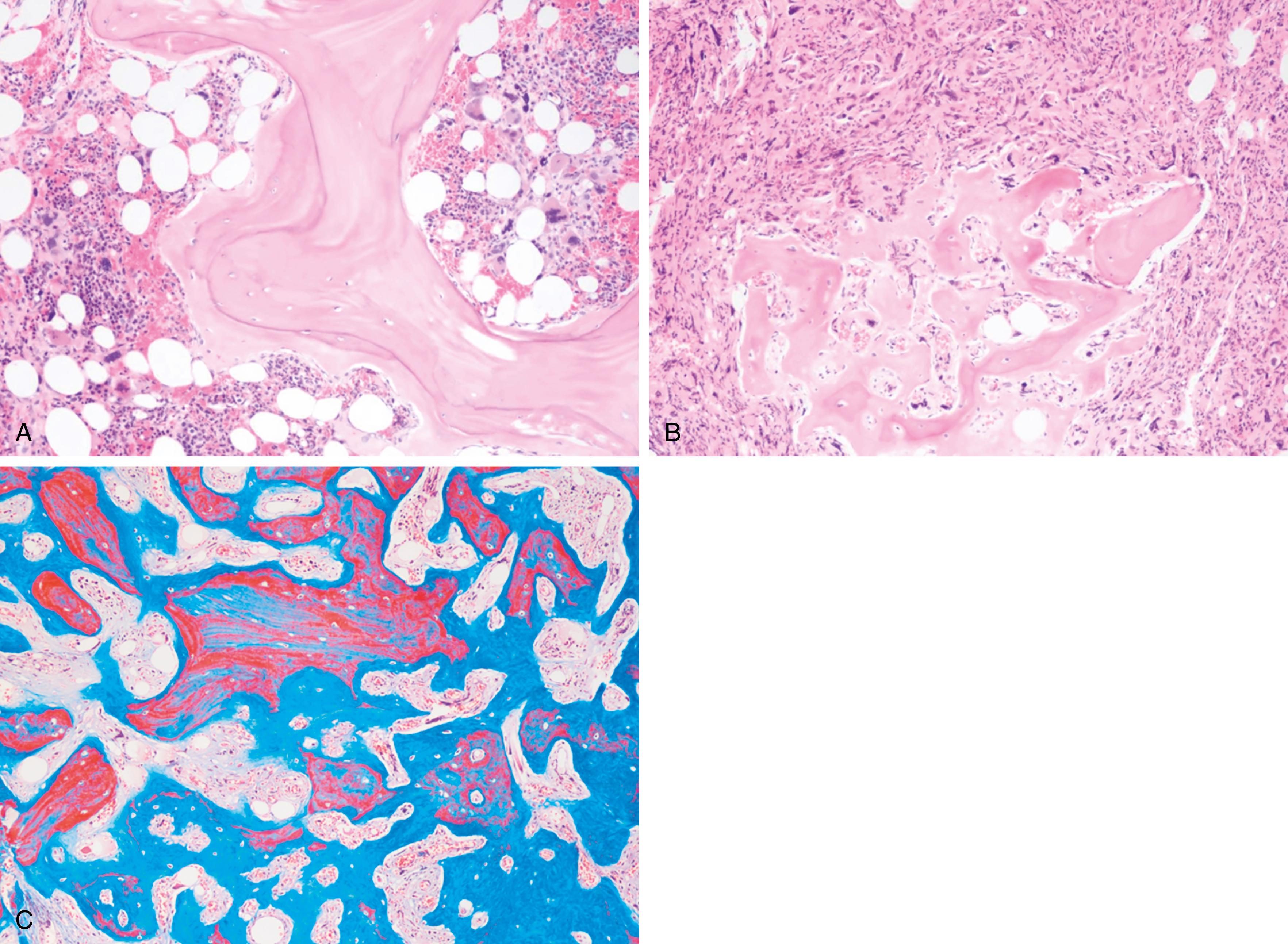 Fig. 5.3, Osteosclerosis is often present in the setting of significant bone marrow fibrosis. Note the thickened bony trabecula with collagen deposition at the periphery (A) and focus of woven bone formation (B). Collagen lining the bony trabeculae and throughout woven bone is highlighted by trichrome stain (C). (A, B, Hematoxylin-eosin stain, ×100; C, trichrome stain, ×100.)