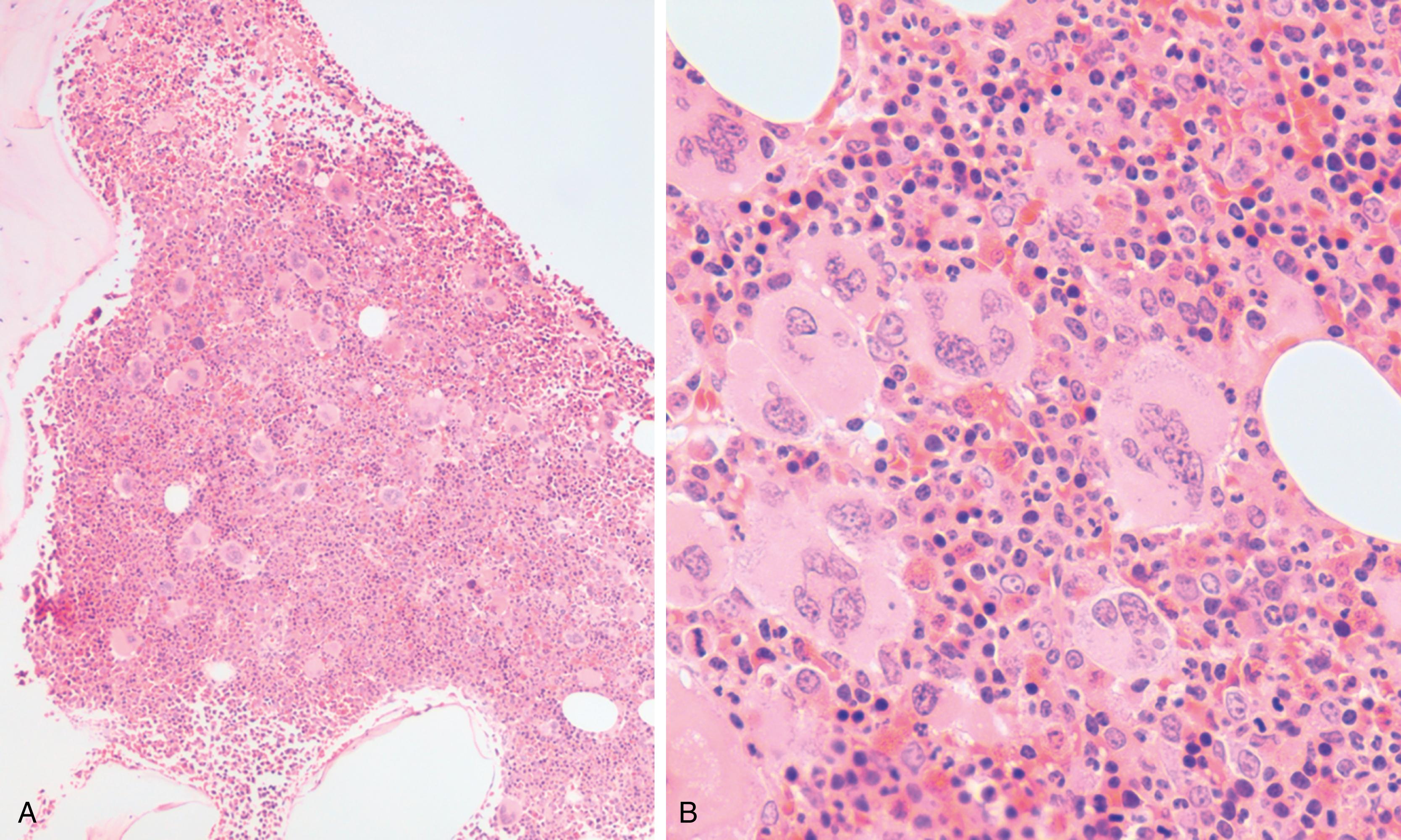 Fig. 5.5, Polycythemia vera.