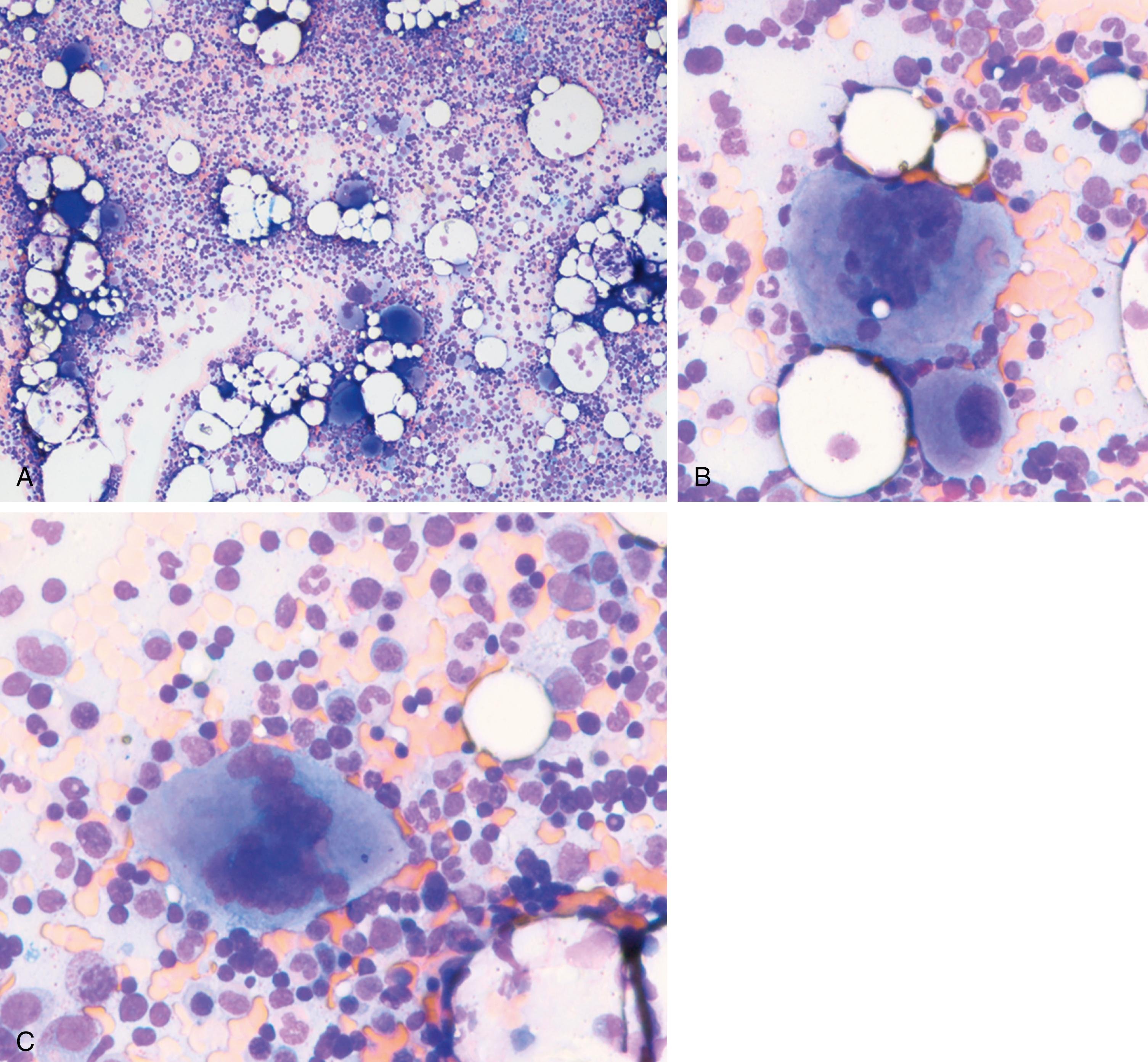 Fig. 5.6, (A through C) Polycythemia vera. The bone marrow aspirate smear shows hypercellular marrow, with increases in all lineages. Megakaryocytes show pleomorphism, including forms with conspicuously hyperlobulated nuclei. (Wright-Giemsa stain; A, original magnification, ×100; B, C, original magnification, ×400).