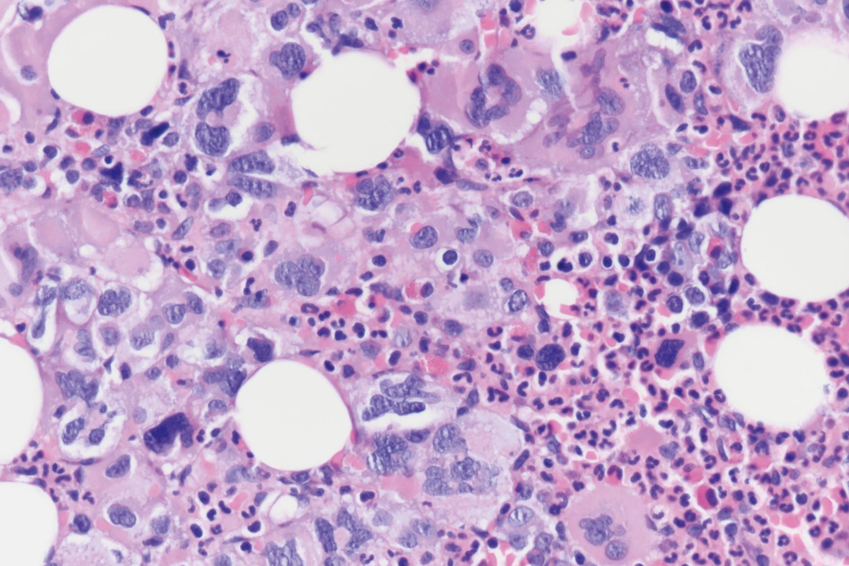 Fig. 5.7, This marrow biopsy specimen from a 55-year-old man with JAK2 -positive polycythemia vera shows hypercellular marrow for age with a marked increase in megakaryocytes ranging in size from small to large, micromonolobulated to polylobulated forms, clustering in more than 7 cells.