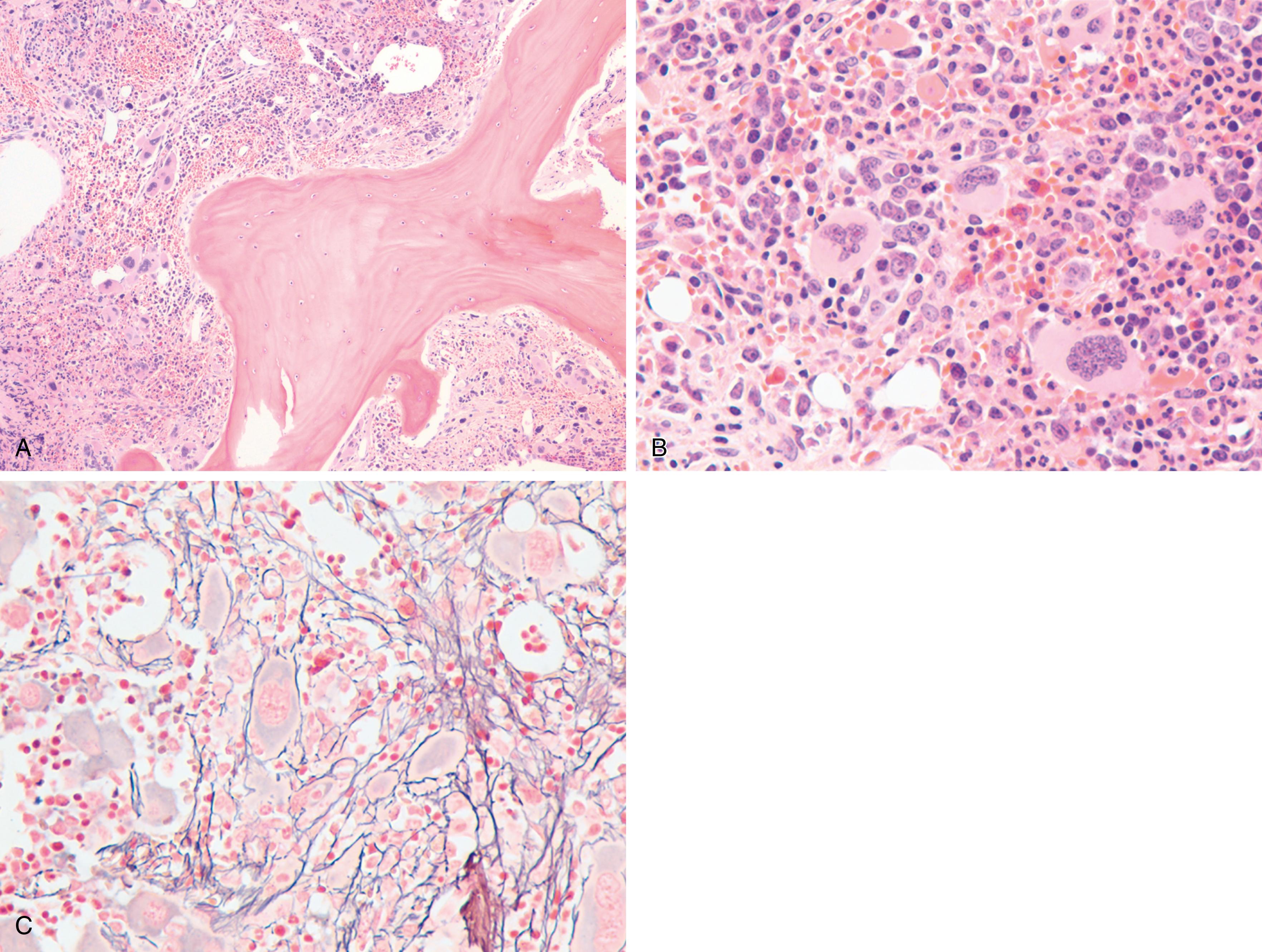 Fig. 5.8, Post-polycythemic myelofibrosis.