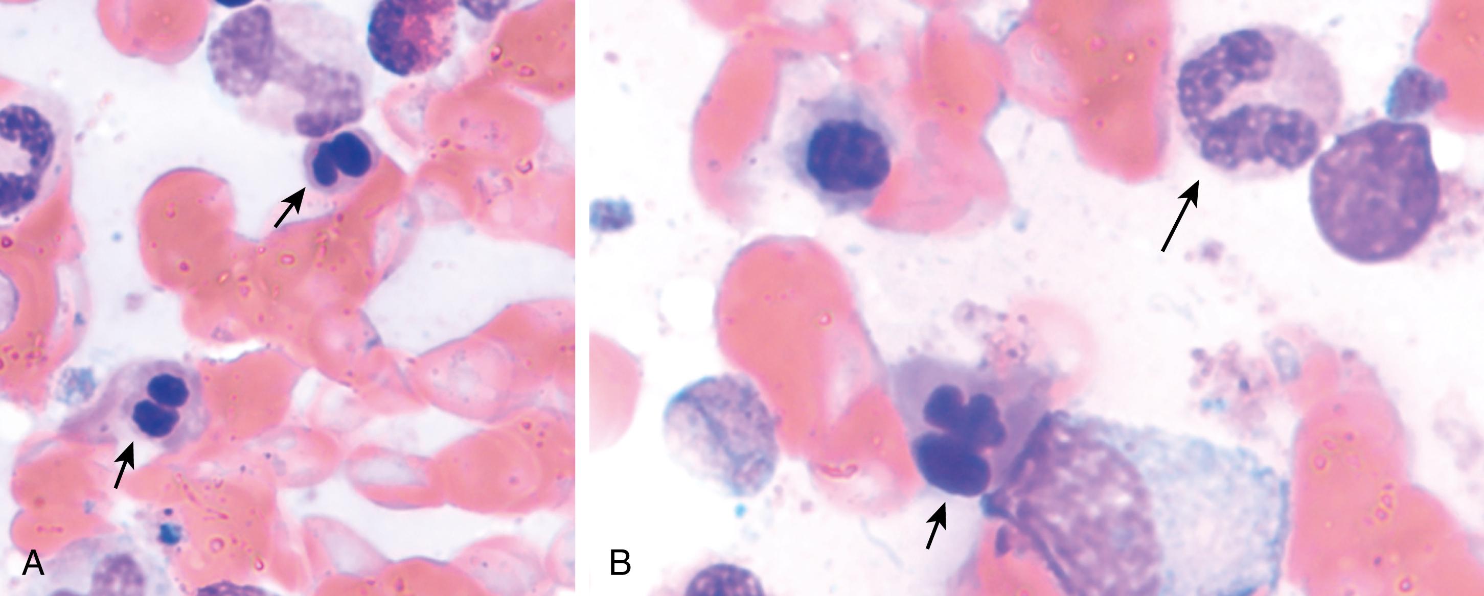 Fig. 5.9, (A, B) Bone marrow aspiration smear showing myelodysplastic syndrome–like progression in a patient with a history of polycythemia vera. There are dysplastic erythroid precursors with irregular nuclear contours ( short arrows ), and an atypical bilobed neutrophil, or pseudo–Pelger-Huet cell ( long arrow ). (A, B, Wright-Giemsa stain, ×1000.)