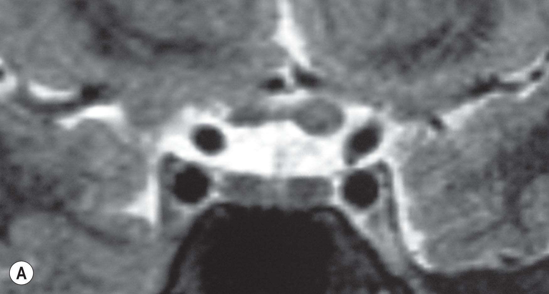 Fig. 100.2, A 14-year-old boy with known neurofibromatosis type 1 and a known glioma of the left optic nerve and chiasm (A) was complaining of intermittently seeing shapes in his left eye and sometimes also in both eyes (B and C).