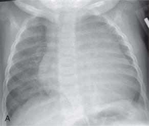 Figure 79.2, Dilated cardiomyopathy.