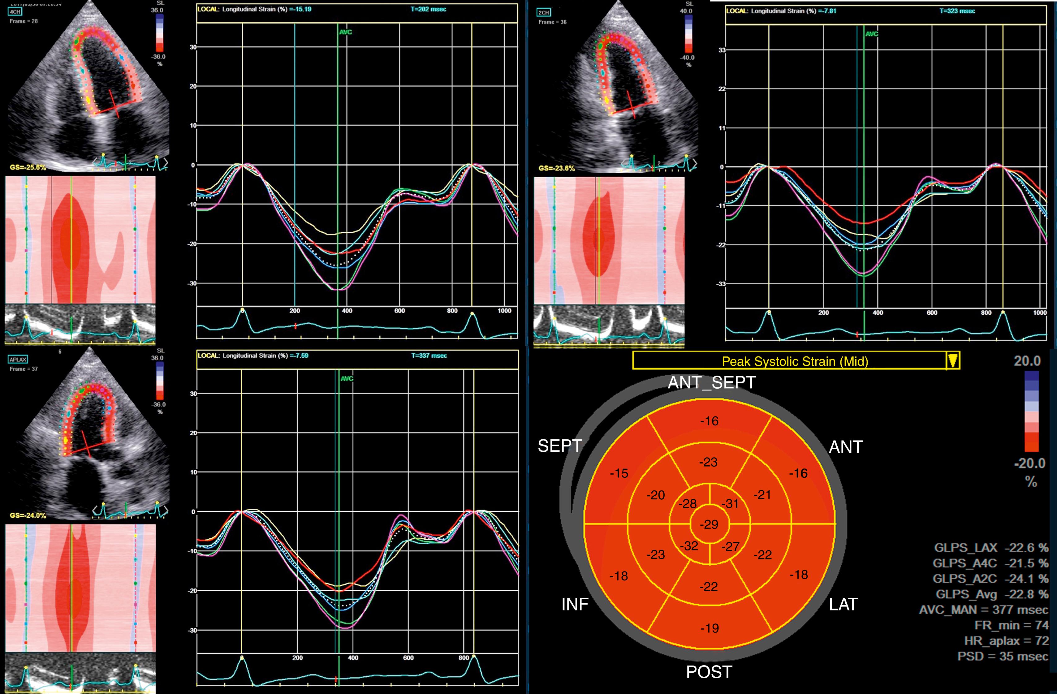 Figure 26.1, An example of longitudinal strain used to determine global longitudinal strain (GLS). The apical four-chamber view (upper left) , apical two-chamber view (upper right) , apical long-axis view (lower left) , and bull’s-eye polar plot (bottom right) . The GLS in this example is 22.8% (in absolute values).