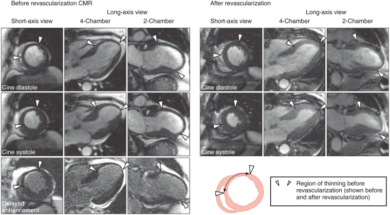 FIG. 21.1, A patient with subendocardial scar and regional akinesia and wall thinning. Left , Before revascularization, cine-cardiovascular magnetic resonance (CMR) still frames in systole and diastole demonstrate akinesis and thinning of the anteroseptal, anterior, and apical walls. Delayed-enhancement images demonstrate limited scar burden (≤50%) within the thinned region. Right, After revascularization, cine-CMR still frames demonstrate improvement in myocardial contractility along with reversal of thinning in the previously thinned region. End-diastolic wall thickness changed from 4.5 to 9.5 mm after revascularization.