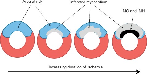 Figure 10.1, Pathophysiology of MI: ischemia wave-front phenomenon of myocardial infarction. MO = microvascular obstruction. IMH = intramyocardial hemorrhage