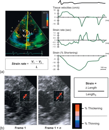 Figure 10.11, (a) Strain imaging in a normal subject. Examples of tissue Doppler imaging velocity, strain rate, and strain curves for a cardiac cycle from a subject with normal cardiac function. L, length; V, velocity. Reproduced with permission from Ref. [ 27 ]. (b) Speckle tracking strain by echocardiography diagram of speckle tracking strain from 2-dimensional short-axis echocardiographic images.