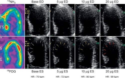 Figure 10.14, Inotropic response to dobutamine in dysfunctional segments (white arrows) with normal rest flow ( 13 NH 3 ) and F-18-fluorodeoxyglucose ( 18 FDG) uptake. The upper row shows images obtained from the apical four-chamber view in end-diastole at baseline and during the infusion of 5, 10, and 20 μg kg − 1 min − 1 of dobutamine. The lower row shows the corresponding end-systolic images. The yellow arrows indicate segments improving function, whereas red arrows indicate deteriorating segments. The sequence illustrates a typical biphasic response in the distal septum and the apex. Since blood flow and FDG uptake are normal in these segments, this is an example of chronically stunned myocardium.