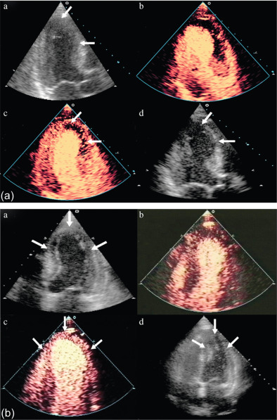 Figure 10.15, (a) End-systolic frames of the apical three-chamber view showing: (Aa) akinetic mid-anterior septum and apex (arrows); (Ab) complete destruction of myocardial contrast immediately after a high mechanical index pulse on MCE; (Ac) lack of contrast opacification of the dysynergic segments, even at 15 cardiac cycles (arrows); (Ad) lack of functional recovery at 12 weeks despite revascularization (arrows). (b) End-systolic frames of the apical four-chamber view showing: (Ba) akinetic mid-septum, apex, and mid-lateral segments (arrows); (Bb) complete destruction of myocardial contrast immediately after a high mechanical index pulse on MCE; (Bc) homogenous contrast opacification of the dysynergic segments by 15 cardiac cycles (arrows); (Bd) functional recovery at 12 weeks after revascularization (arrows).