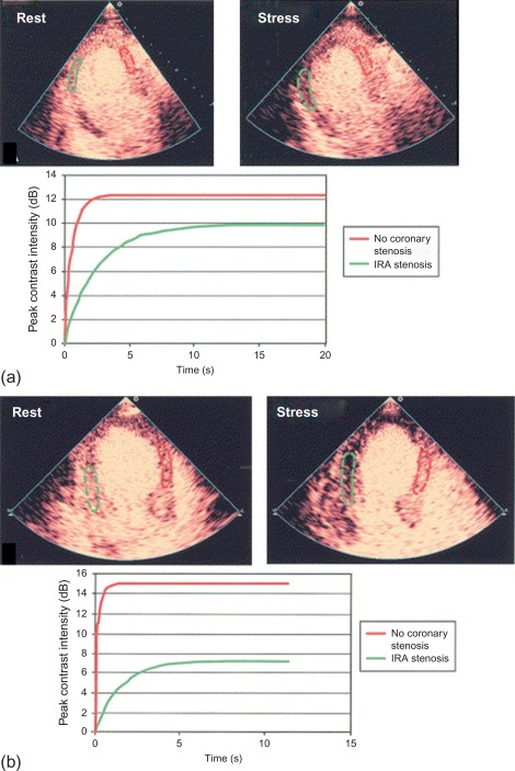 Figure 10.16, (a) Apical three-chamber view shows reversible perfusion defect (posterior wall) at the infarct site. (b) Apical three-chamber view shows reversible perfusion defect in the remote, normally contracting mid-posterior segment in a patient with an anterior acute myocardial infarction. (Graphs) Replenishment curves demonstrate reduced peak contrast intensity (MBV—α) and rate of replenishment (myocardial blood velocity—β) during stress, suggesting residual infarct-related artery (IRA) stenosis (A) and multivessel disease (B). Red indicates no coronary stenosis; green indicates significant coronary stenosis.