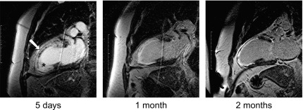 Figure 10.4, Contrast-enhanced MR demonstrating progressive changes occurring during infarct healing of a large anterior MI over a 2-month period (arrow indicates no-reflow, * infarcted area). Area of no-reflow disappears after 1 month, over time, the infarcted area thins and the ventricle slightly enlarges due to remodeling.