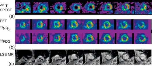 Figure 10.6, Evaluation of infarct size in a patient with a large anterior and small posterior MI by different modalities. Representative short-axis images by (a) rest 201-Tl SPECT, (b) NH 3 -FDG PET, (c) late gadolinium enhanced CMR.