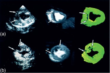 Figure 10.7, Evaluation of microvascular obstruction by contrast echo (left panels), contrast-enhanced CMR (middle panel).