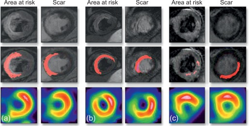 Figure 10.8, Evaluation of risk area with T2 weighted CMR and scar using late gadolinium enhancement by CMR and nuclear imaging. The top row shows CMR images, the middle panel shows the same images with the area at risk and scar delineated in red and the bottom row shows stress and rest nuclear perfusion images.