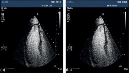 Figure 10.10, Apical three-chamber view from a subject with suboptimal endocardial visualization (a) improving dramatically after 0.3 mg of sonovue contrast injection (b).