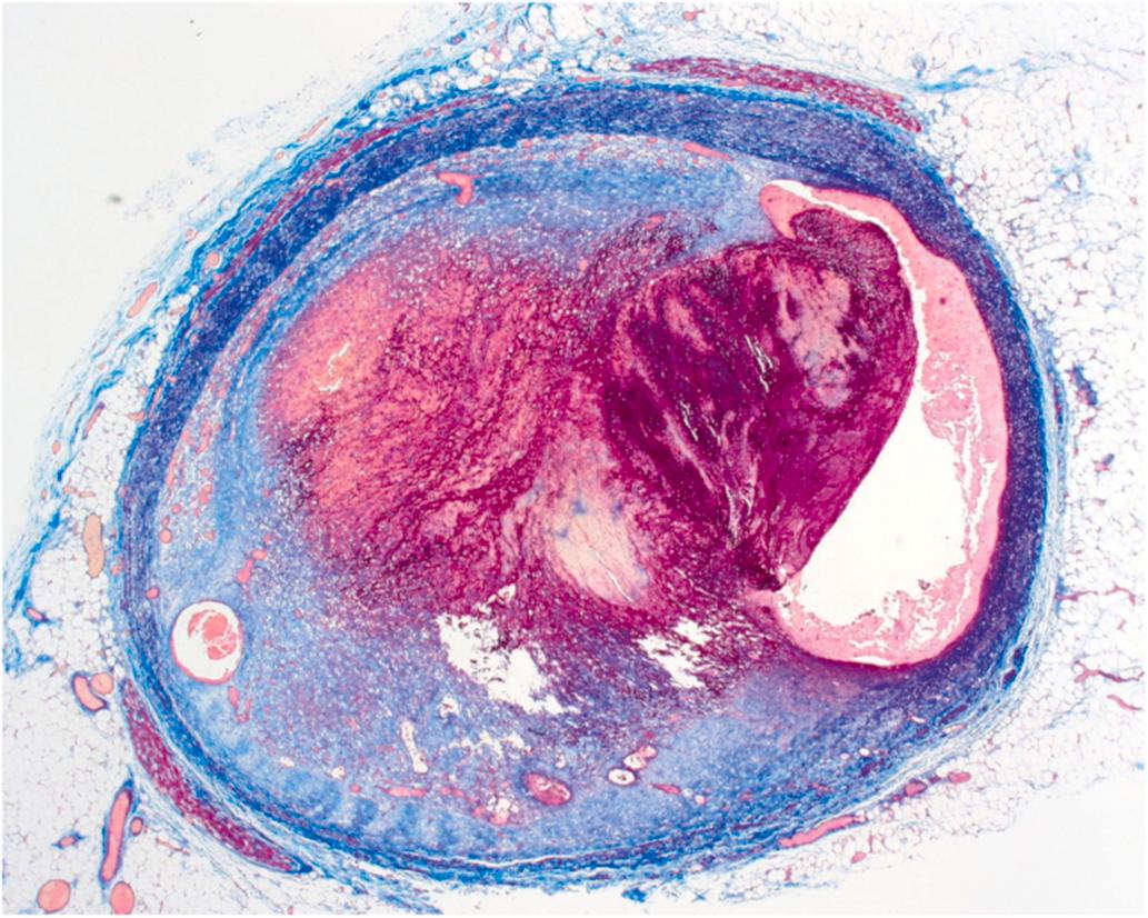 Figure 10.11, Underlying lesion in the great majority of acute coronary events: rupture of an atherosclerotic plaque with superimposed luminal thrombosis (trichrome stain 12.5×).