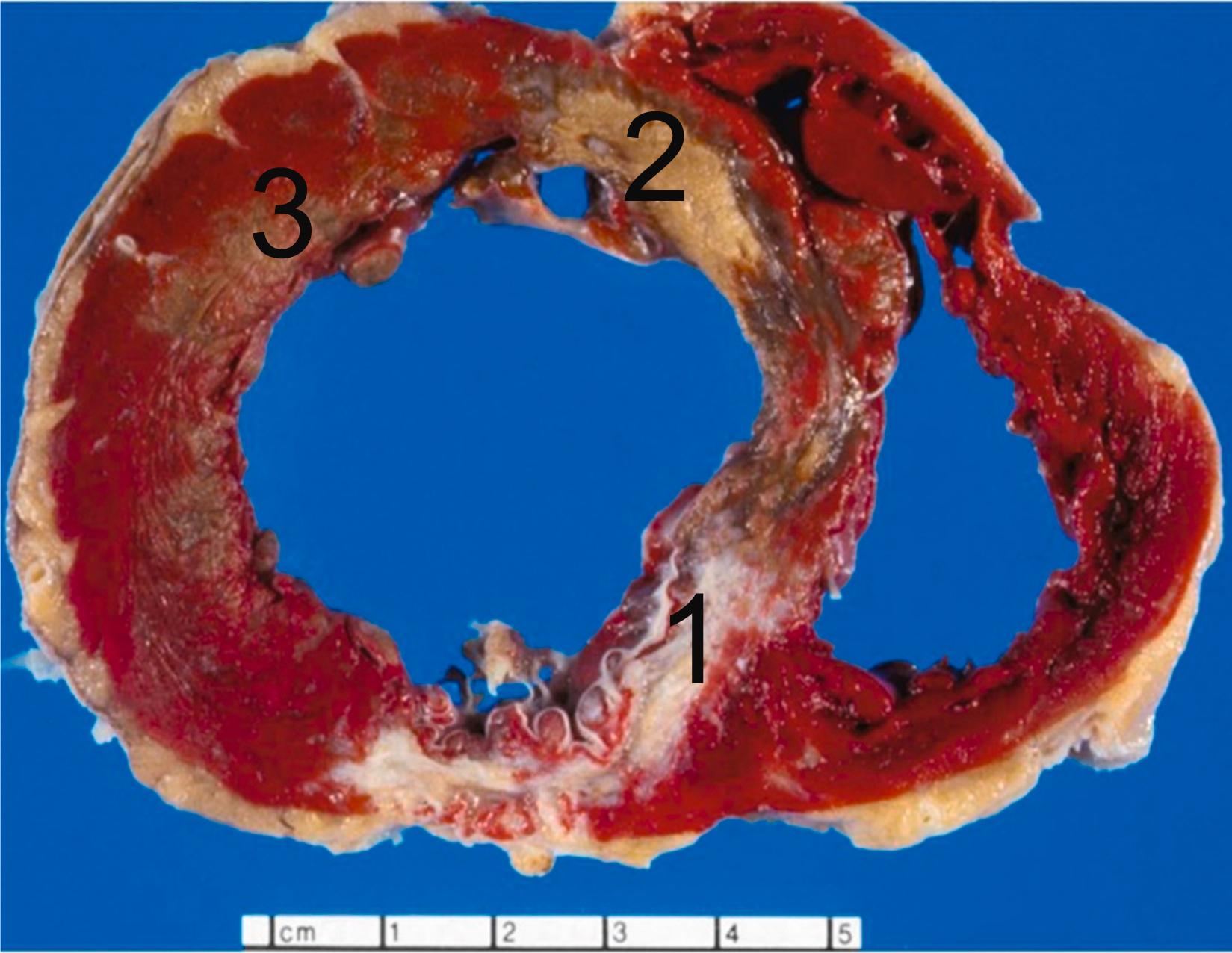 Figure 10.13, Gross changes of myocardial infarction (MI). There are three infarcts of different ages present in this triphenyltetrazolium (TTC) stained transverse slice of ventricles: (1) old, healed, posterior wall transmural infarction; (2) subacute, days old, anteroseptal infarction (note residual necrotic myocardium and granulation tissue); and (3) acute, hours-old, subendocardial lateral wall infarction.