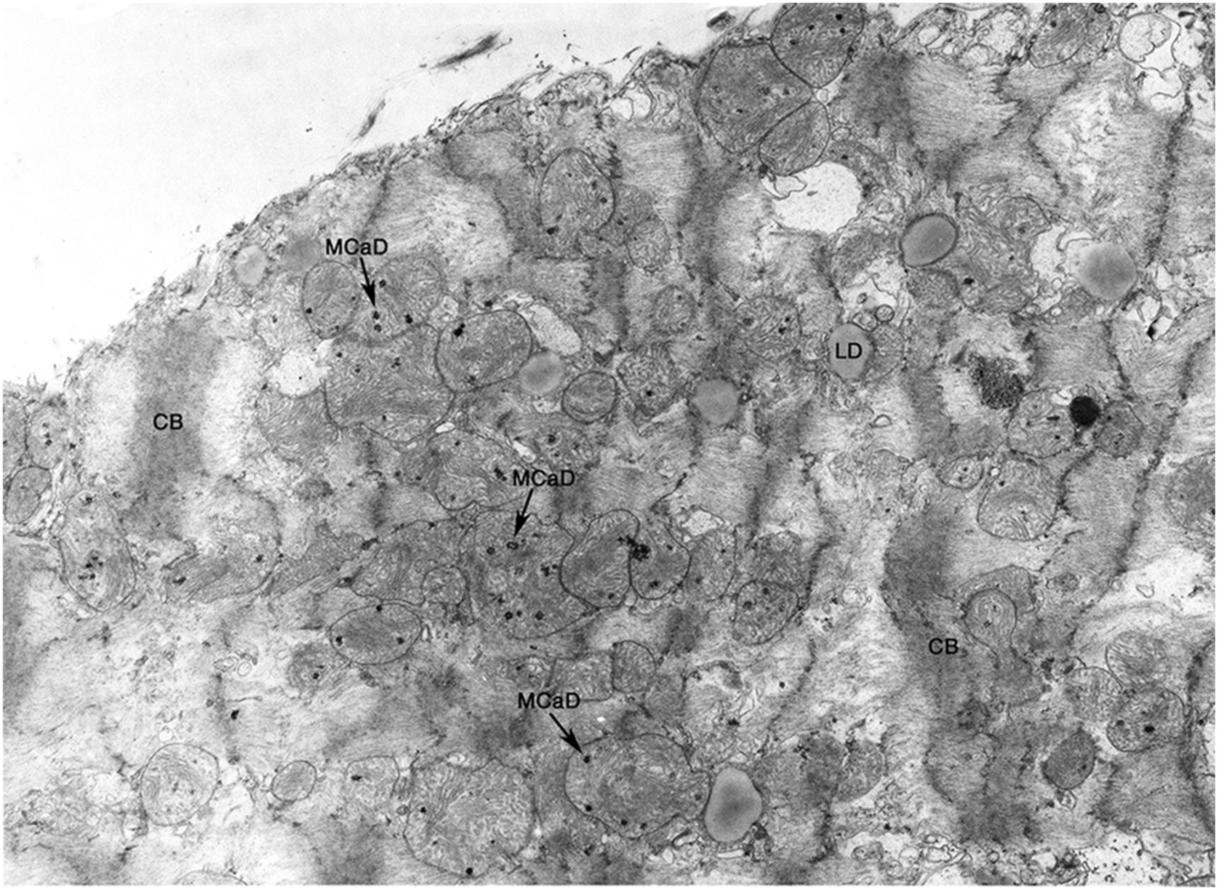 Figure 10.3, Ultrastructure of ischemic cardiomyocyte with features of contraction band formation and calcium overload as seen in the peripheral zone of an evolving canine myocardial infarct. Note the foci of myofibrils condensed into bands (CB), the lipid droplets (LD), and granular mitochondrial calcium phosphate deposits (MCaD). Electron micrograph, 6500×.