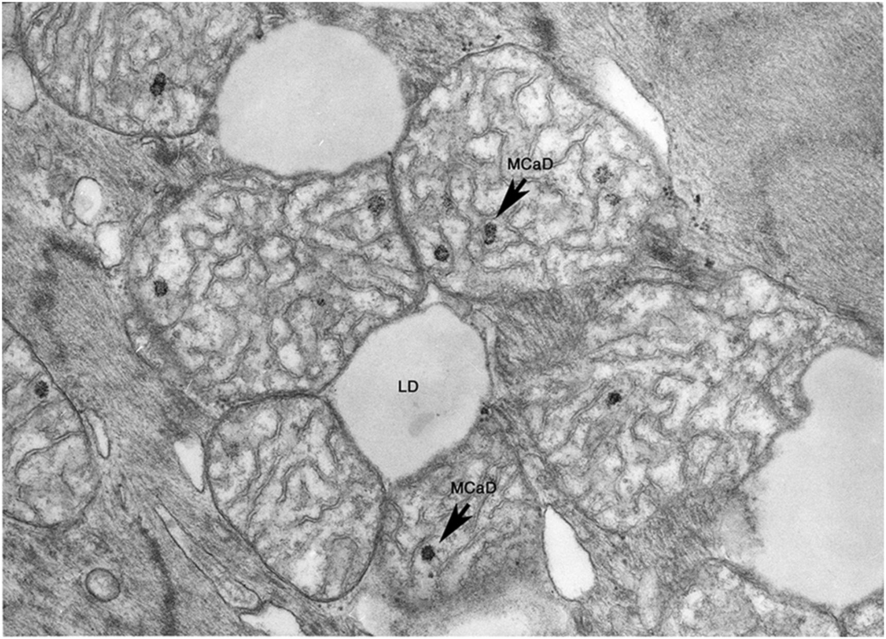 Figure 10.4, Ultrastructural detail of ischemic cardiomyocyte with lipid deposits (LD) and swollen mitochondria containing very electron-dense, annular-granular calcium phosphate deposits (MCaD). As ATP is reduced, mitochondrial oxidative capacity is decreased, leading to an accumulation of re-esterified fatty acids as lipid droplets. As the sarcolemmal function becomes impaired, an increase in calcium influx occurs. With reperfusion, further calcium influx is coupled with an oxidative burst generating toxic oxygen-based radicals. The excess calcium triggers hypercontraction of the myofibrils manifest as contraction bands. The overload of calcium ions and toxic oxygen-based radicals leads to opening of the mPTP, loss of membrane potential, swelling, and collapse of ATP generation. Electron micrograph 26,000×.