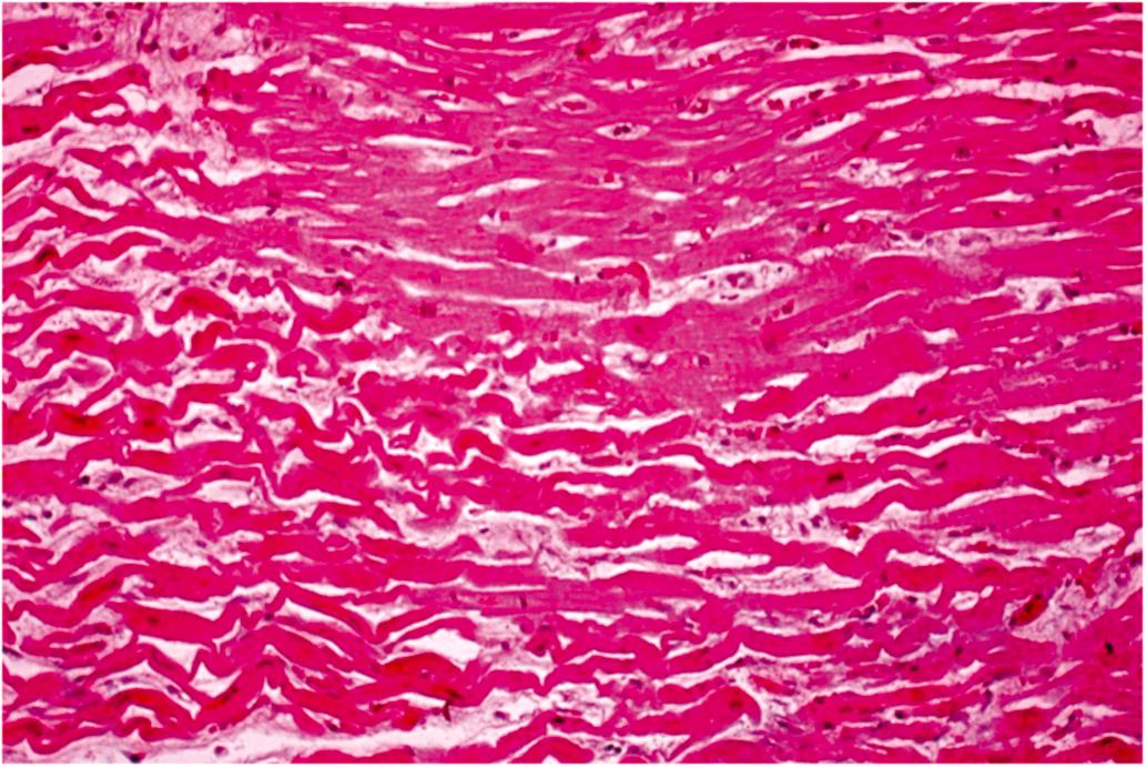 Figure 10.6, Histologic section of left ventricle from a patient who died 8 h after the onset of chest pain. Note the necrotic myocardium (left) has brick-red change and wavy fibers (H&E stain, 100×).