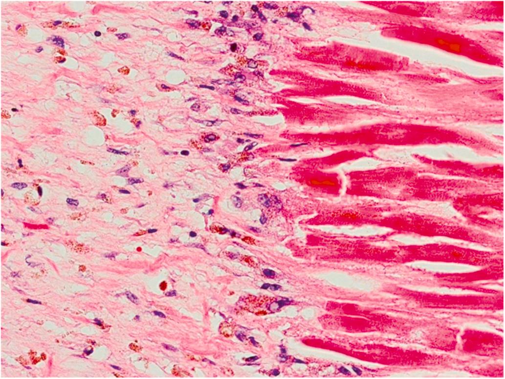 Figure 10.7, Edge of myocardial infarction (MI) 2 weeks old. Inflammatory cells are mostly gone, except for a few lymphocytes and macrophages, “mummified” necrotic fibers are still present, and there is granulation tissue with abundant collagen deposition at the edge of the infarct (H&E stain, 400×).