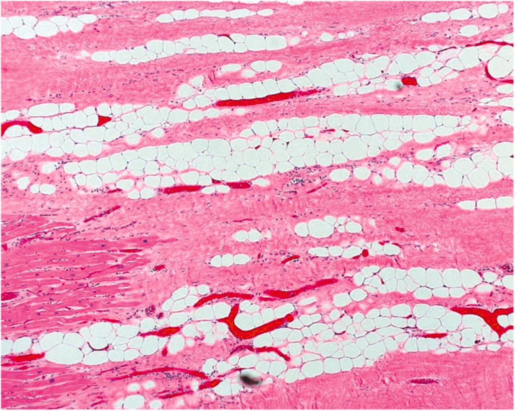 Figure 10.8, Old healed myocardial infarction (MI). Inflammatory cells and granulation tissue are eventually replaced with dense collagenous tissue. In some infarcts, as in this one, there is fatty metaplasia in the scar tissue, not to be confused with similar findings in arrhythmogenic cardiomyopathy (H&E stain, 40×).