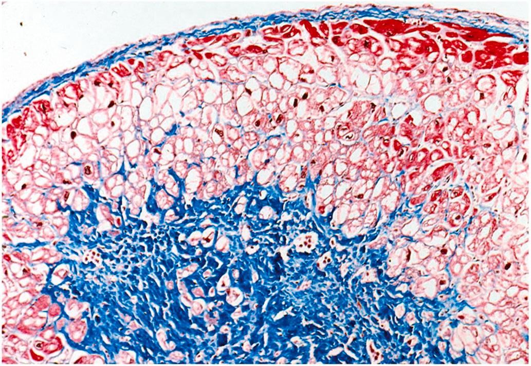 Figure 10.9, Myocytolysis, vacuolar degeneration, a chronic ischemic change of myocardium, often found in territories around an old infarction, as in this case (trichrome stain, 100×).