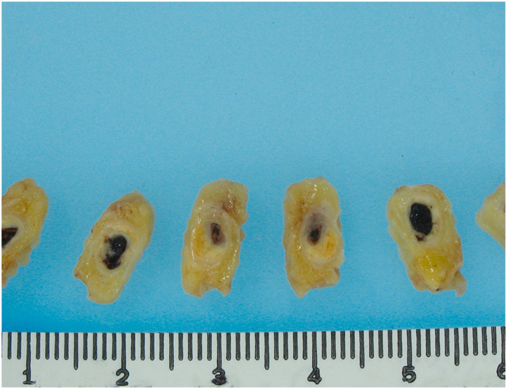 Figure 10.10, Plaque rupture and thrombosis. This stenotic coronary artery demonstrates a large lipid-rich atherosclerotic plaque. There is plaque rupture and superimposed thrombosis, completely occluding the lumen.