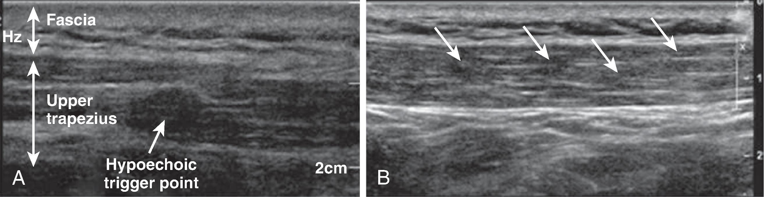 Figure 68.1, Gray-scale imaging of trigger points in the upper trapezius muscle. A, An isolated trigger point appears as a well-defined focal hypoechoic nodule. B, A series of four hypoechoic trigger points in the upper trapezius. (From Sikdar S, Shah JP, Gebreab T, et al. Novel applications of ultrasound technology to visualize and characterize myofascial trigger points and surrounding soft tissue. Arch Phys Med Rehabil . 2009;90:1829-1838, with permission.)