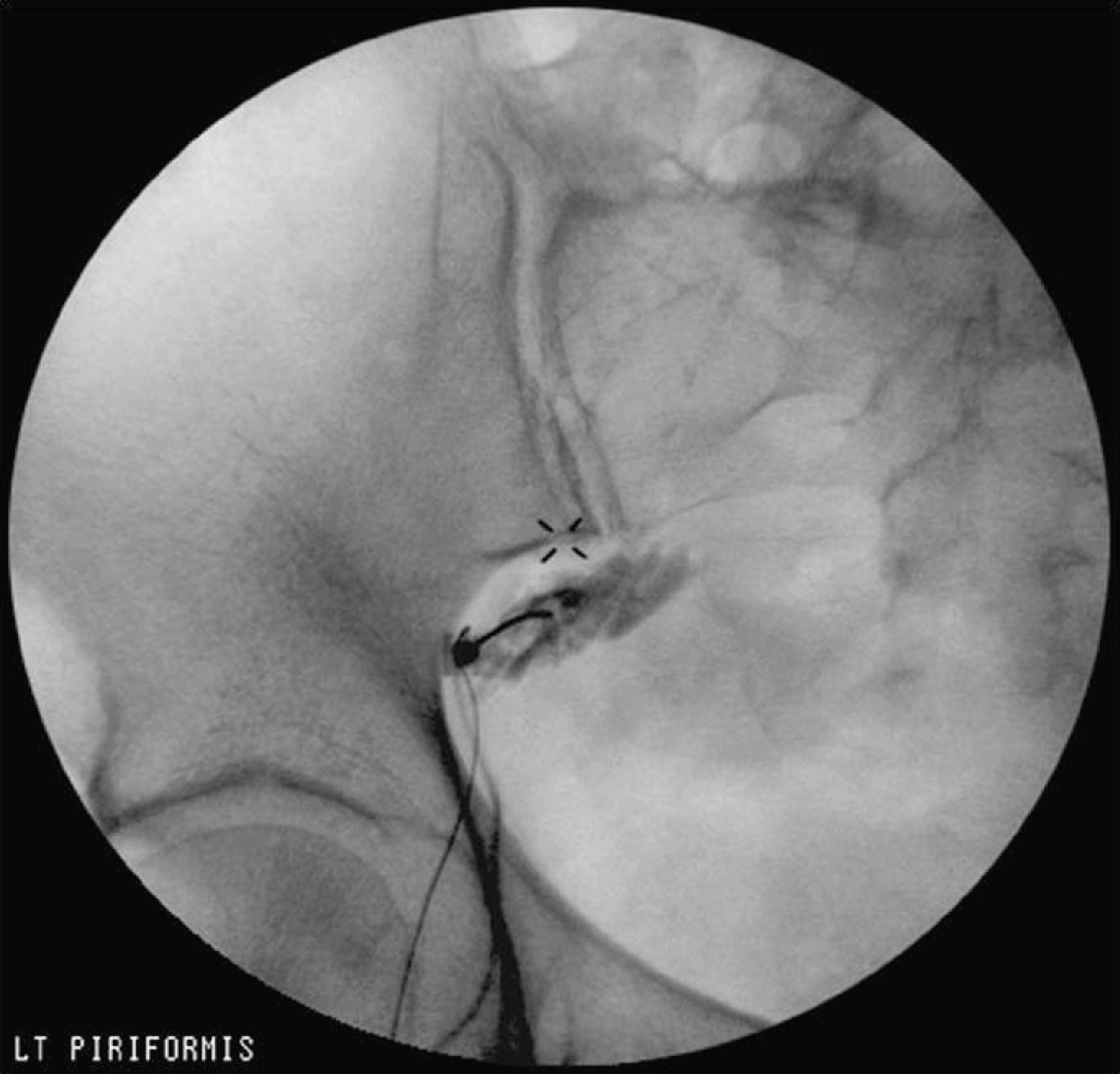 Figure 68.2, Fluoroscopic image guided piriformis muscle injection.