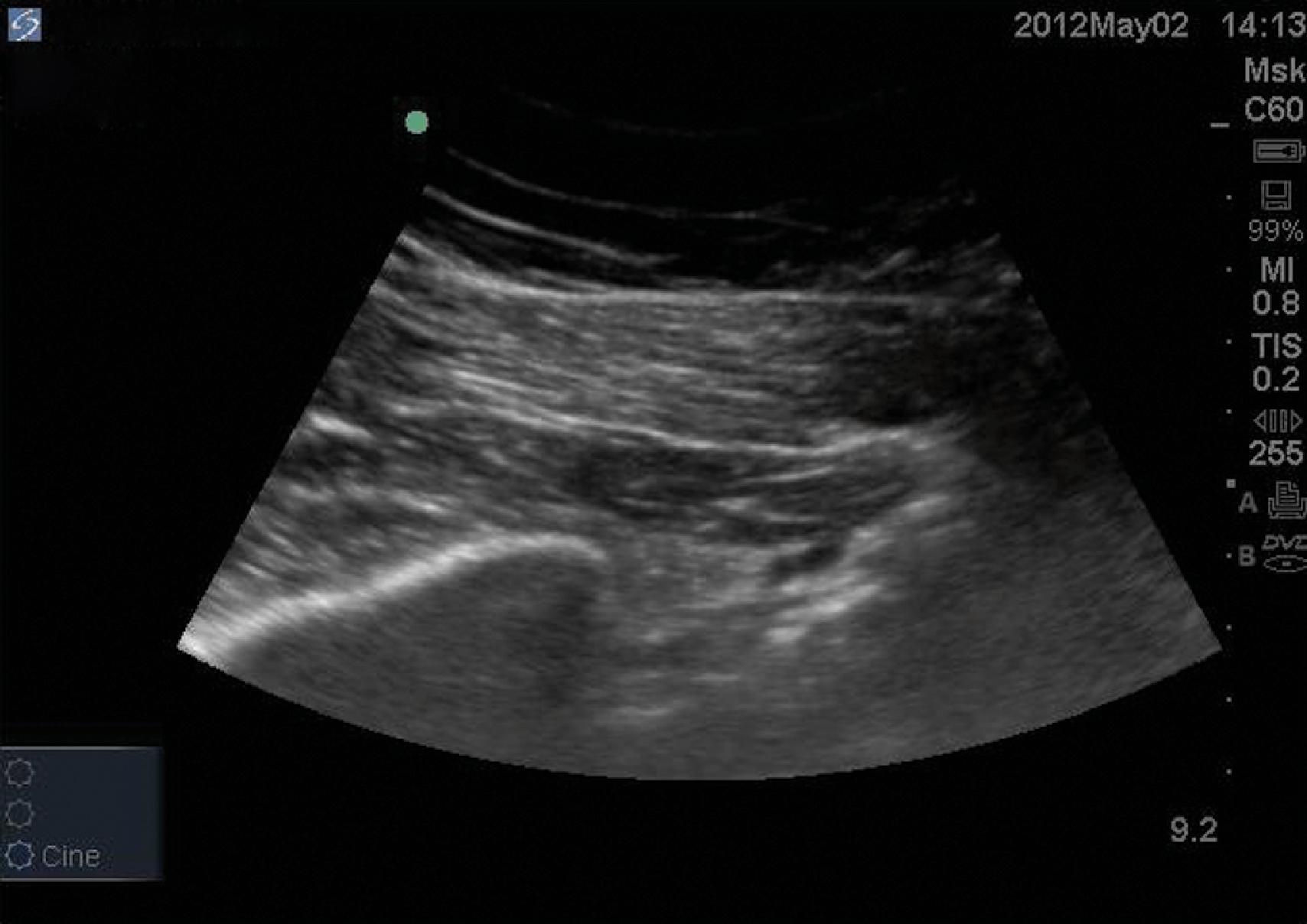 Figure 68.3, Ultrasound anatomy of the piriformis muscle.