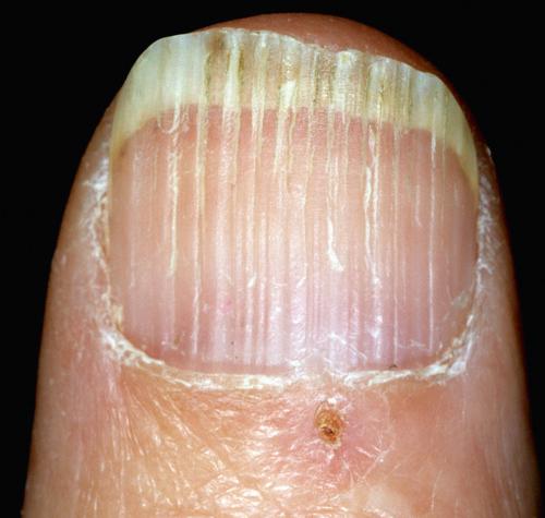 FIG 25.3, Longitudinal ridging. Parallel elevated nail ridges are a common aging change. This change does not indicate any nutritional deficiency.