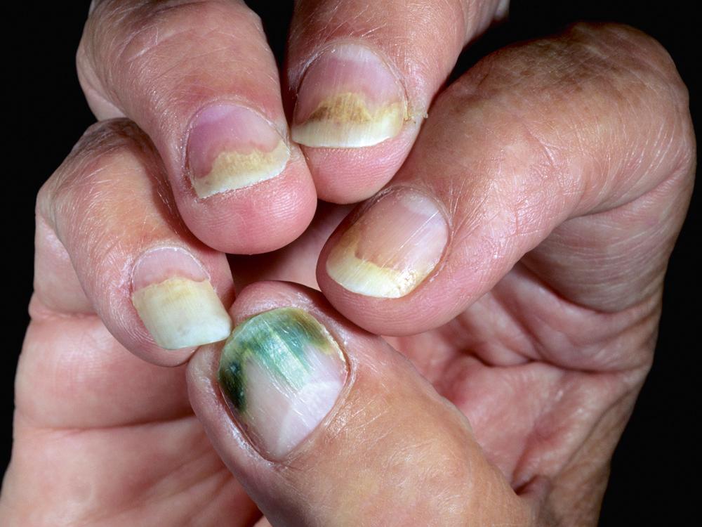 FIG 25.15, Pseudomonas colonized the space between the nail and the nail plate after onycholysis occurred, imparting a green color to the nail plate.