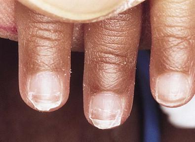 Figure 32.2, Beau's lines are transverse grooves of the nail plate that represent a brief reduction of growth from the nail matrix.