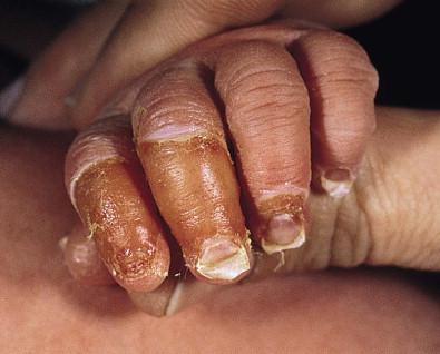 Figure 32.5, Anonychia of the index finger in a case of junctional epidermolysis bullosa.