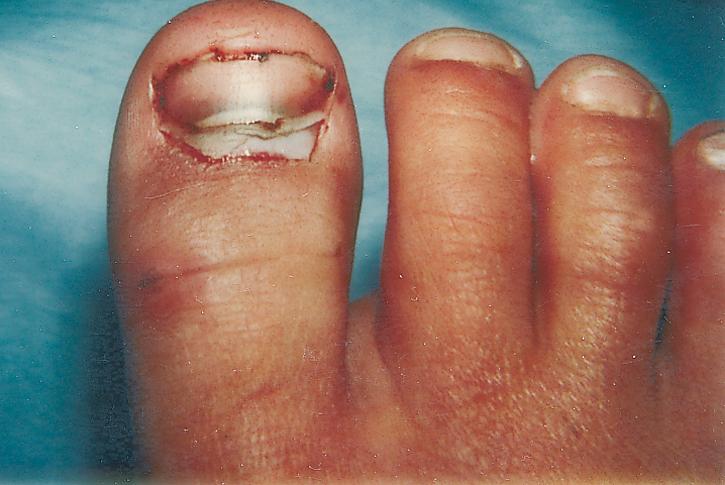 Fig. 145.2, The subtle appearance of a dislocated nail root can be inadvertently overlooked by the clinician.