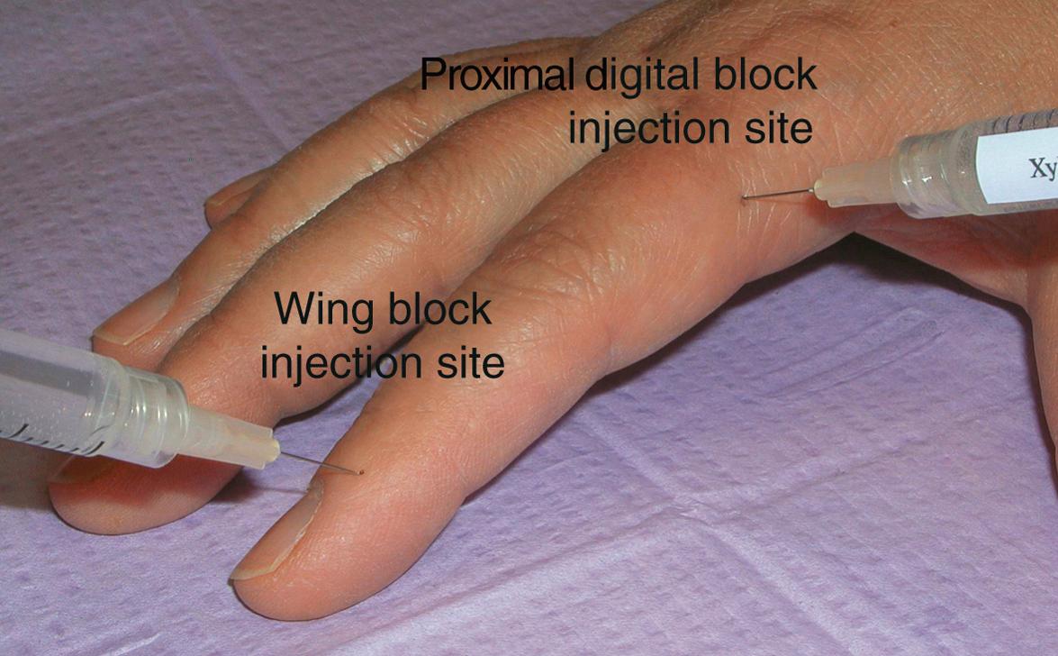 Fig. 149.3, Proximal and distal digital blocks – locations for injection of anesthetic.