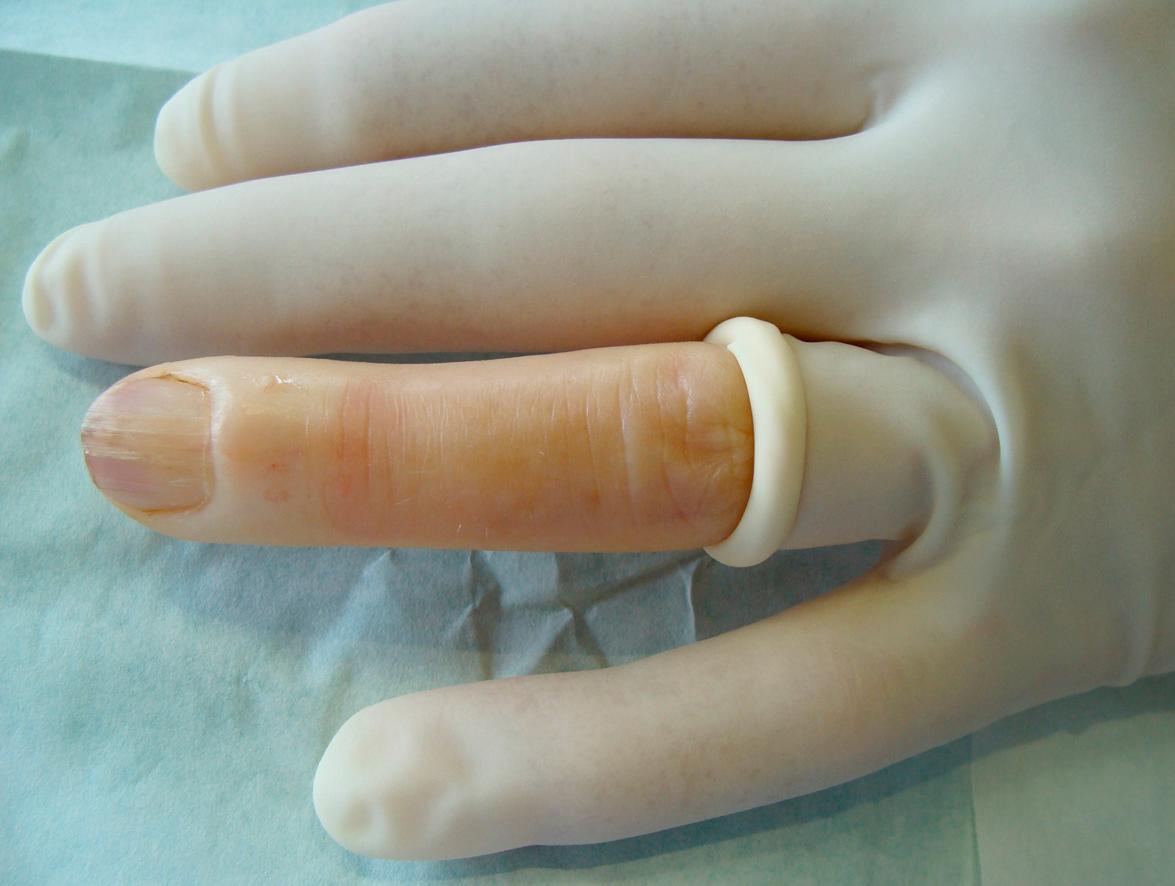 Fig. 149.6, Sterile glove used as a tourniquet and sterile field.