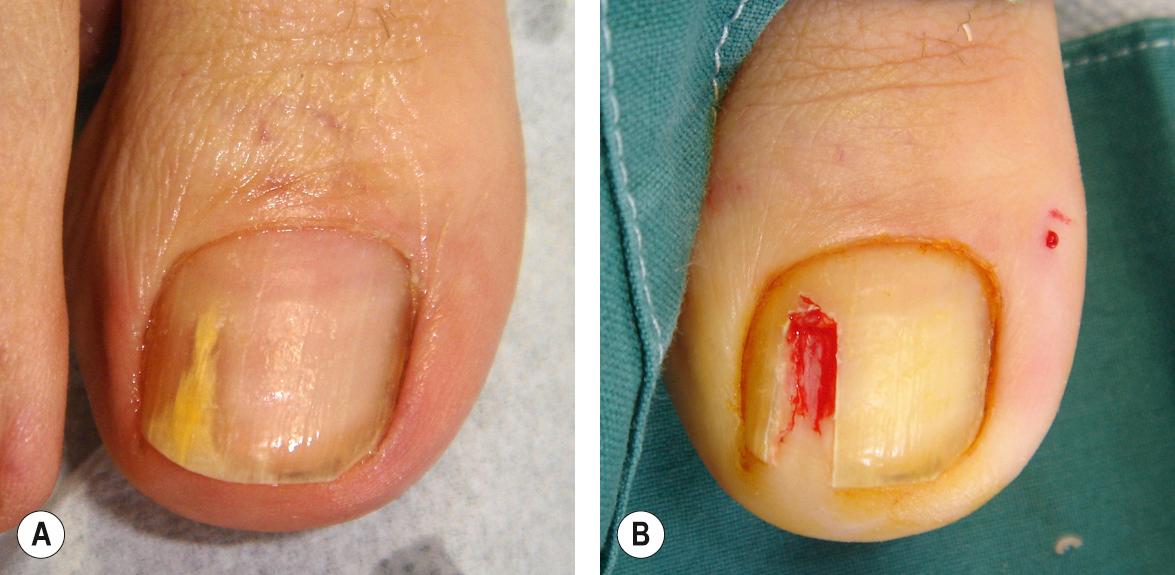 Fig. 149.8, Treatment of a dermatophytoma.