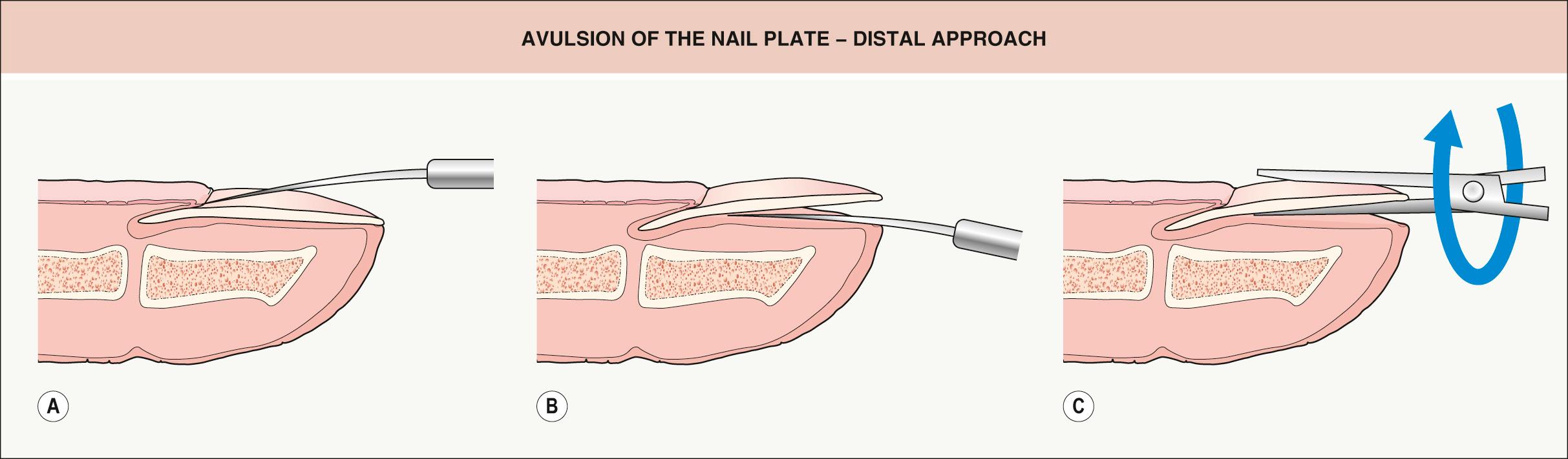 Fig. 149.9, Avulsion of the nail plate – distal approach.